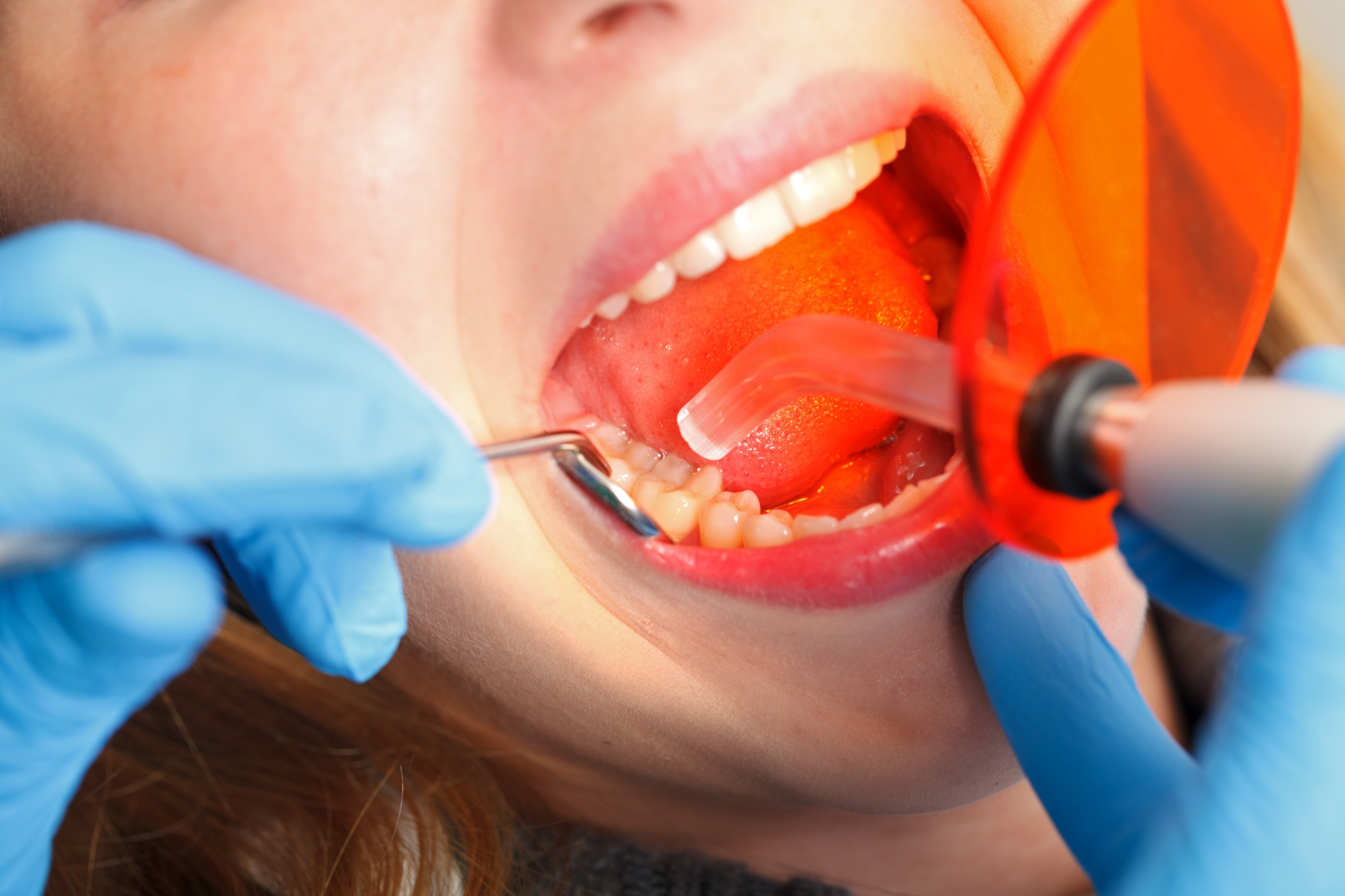 Zahnfüllung: Vor- und Nachteile der verschiedenen Füllungen
